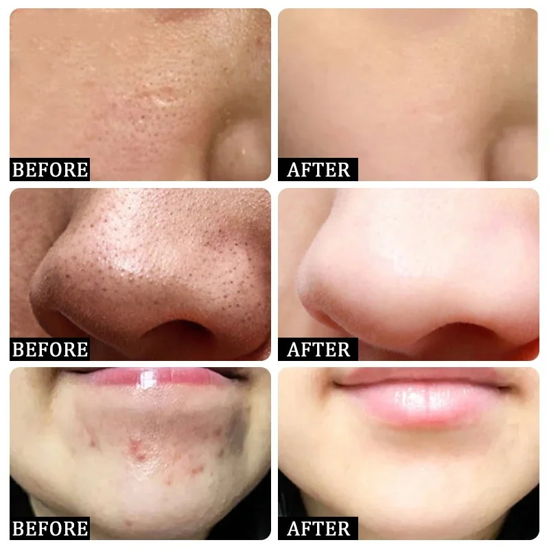 살리실산 모공 클리어링 크림 모공 축소 블랙헤드 제거  - Salicylic Acid Blackhead Remover 리뷰 및 가격